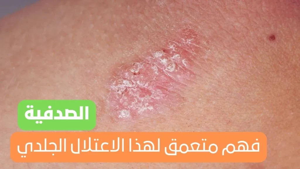 الصدفية