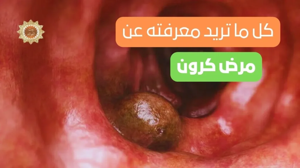 مرض كرون