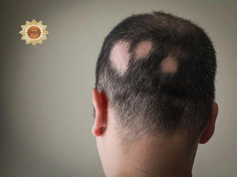العلاج الطبيعي لداء الثعلبة